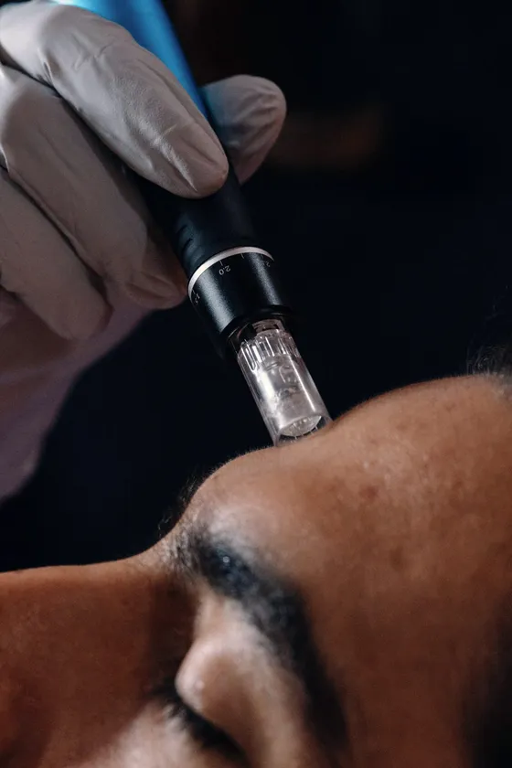 Dermapen (Microneedling) di Laasya Derma Clinic — merangsang kolagen untuk memperbaiki bekas jerawat dan pori