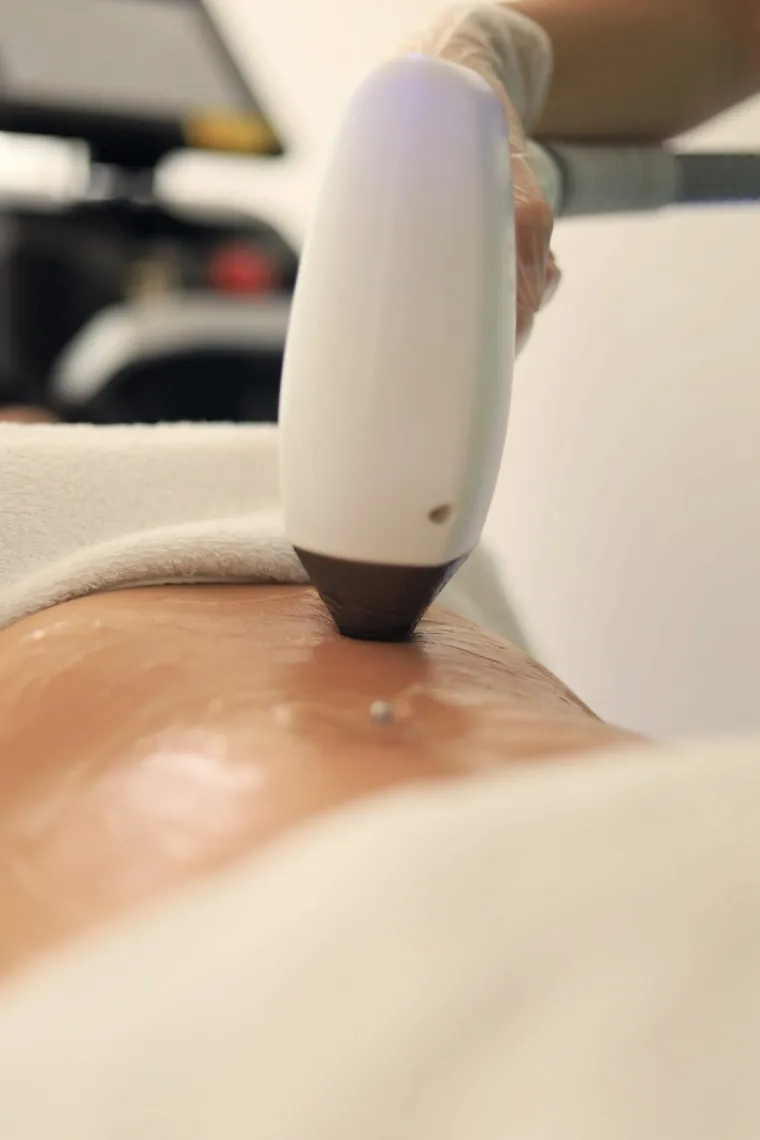 Pico Laser — menargetkan flek dan melasma dengan pulsa sangat singkat